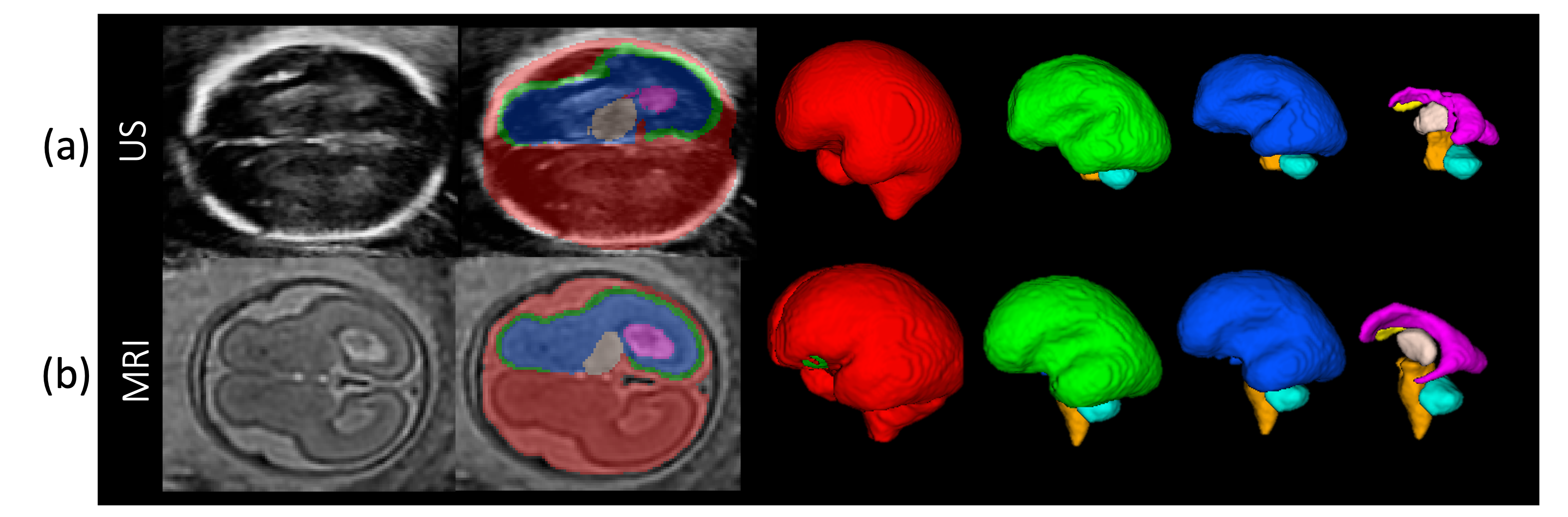 Cross Modality Comparison of Fetal Brain Phenotypes: Insights From Short Interval Second Trimester scp MRI scp and Ultrasound Imaging