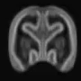 Normative spatiotemporal fetal brain maturation with satisfactory development at 2 years