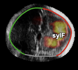 Learning-based prediction of gestational age from ultrasound images of the fetal brain