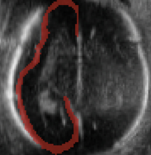 Cortical Plate Segmentation Using CNNs in 3D Fetal Ultrasound