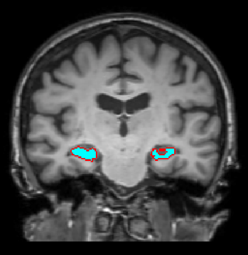 Is Your Style Transfer Doing Anything Useful An Investigation Into Hippocampus Segmentation and the Role of Preprocessing