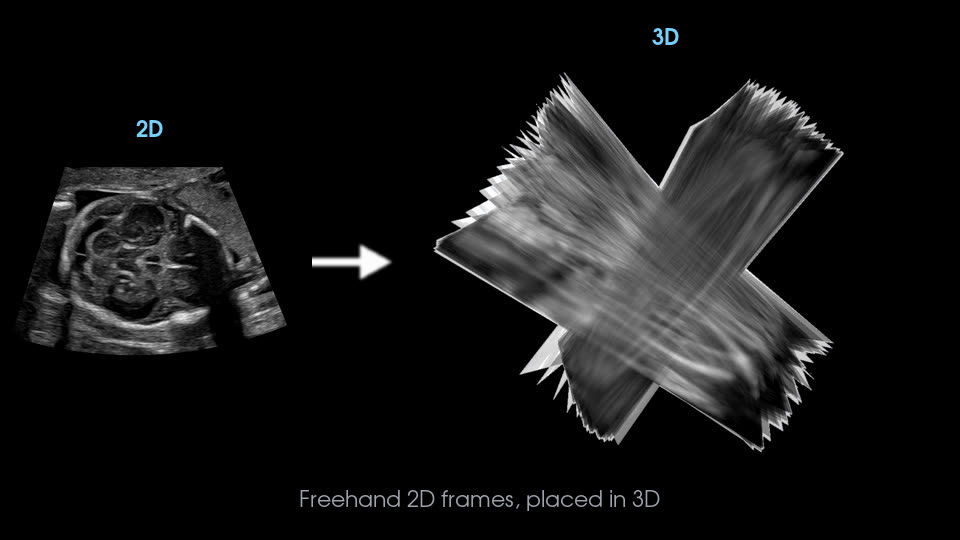 Freehand 2D ultrasound frames placed in 3D