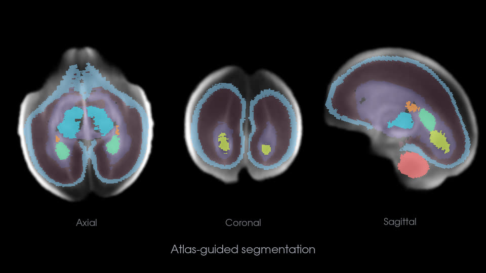 Atlas-guided segmentation of the fetal brain in axial, coronal and sagittal views